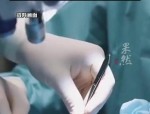 蚌埠美容院隆鼻手术失败 女孩右眼失明 警方已介入