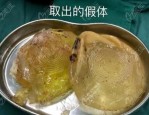 假体隆胸：盐水袋与硅胶假体的手感对比实验及真实体验
